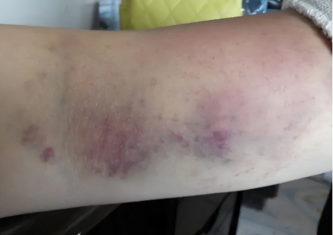 筋膜枪的作用和使用方法,筋膜枪的副作用和危害