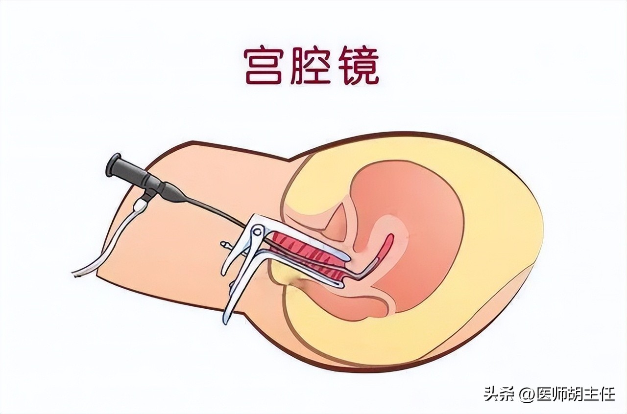 女性为什么容易长子宫肌瘤？提醒：平时尽量避免3个行为，别忽视