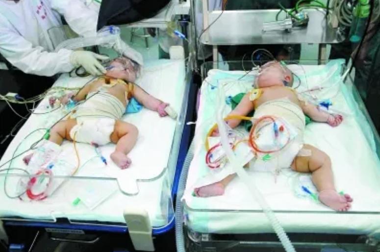 连体婴姐妹18年成功分离,连体婴姐妹成功分离后续