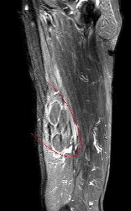 身体上长了个包,身体上长了硬硬的包怎么回事