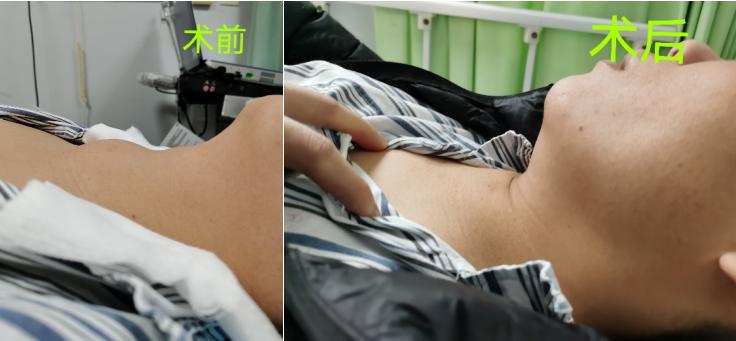 甲状腺囊实性结节微波消融好吗,甲状腺良性结节微波消融术优缺点