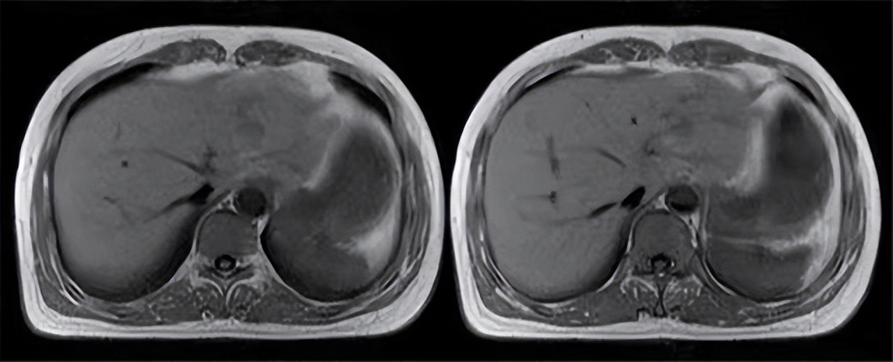 谷丙转氨酶高出多少是肝癌,谷丙转氨酶400谷草200会是肝癌吗