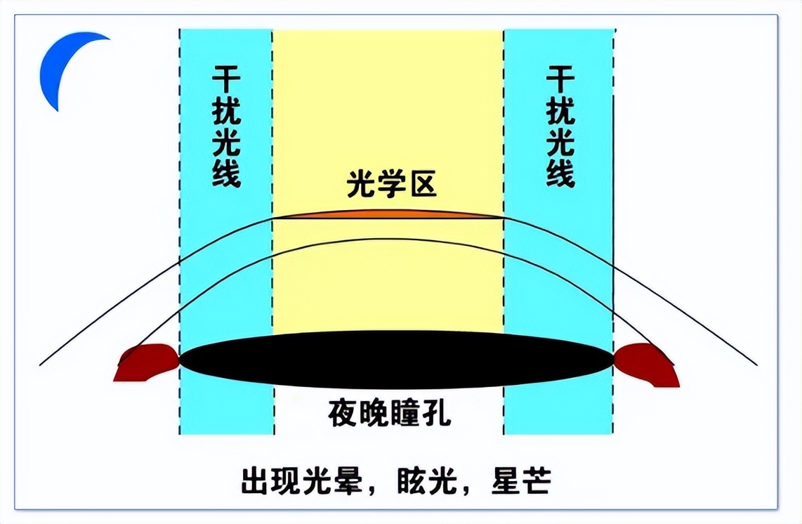 「专家解答」佩戴ok镜后孩子为什么感觉叠影和眩光？