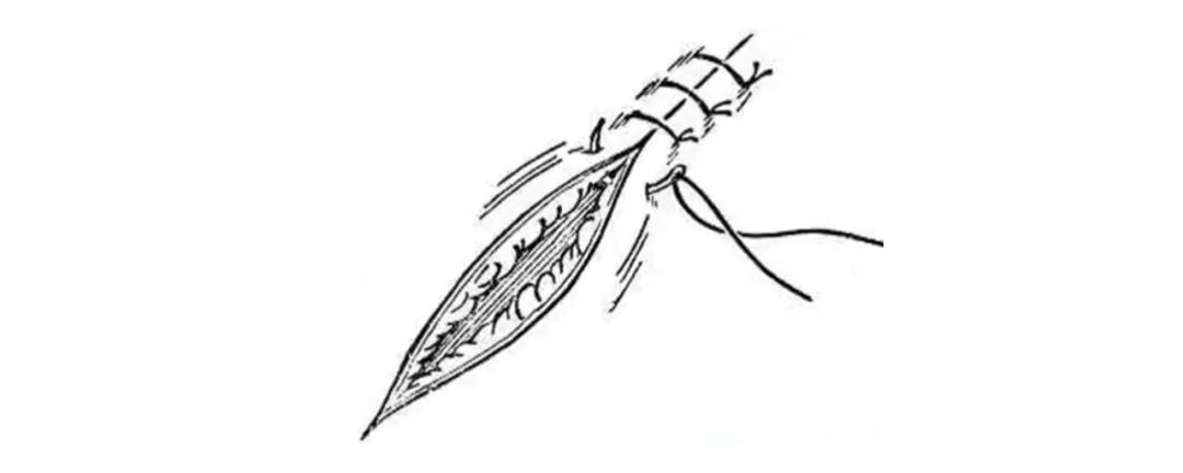 外科缝合技巧你熟练吗,外科缝合术的操作步骤