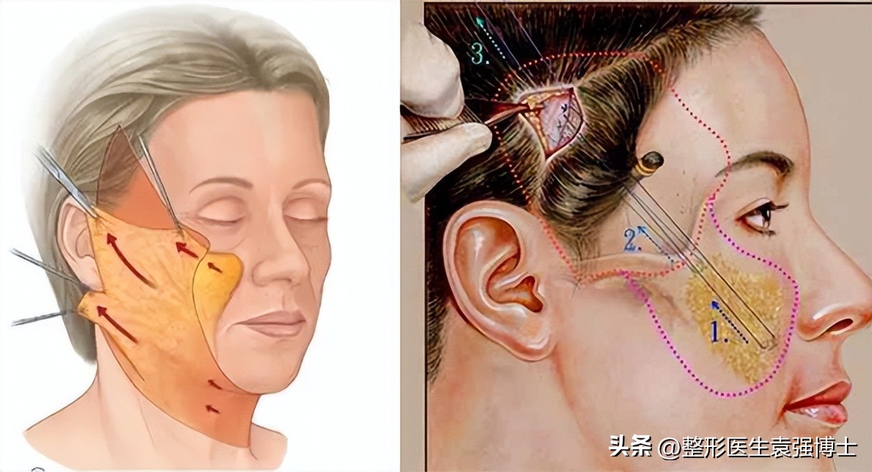 拉皮手术是整形的终极选择吗,整形大拉皮一般多少价格