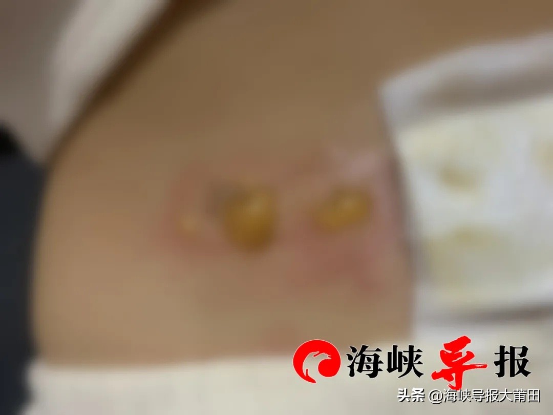 女子调理宫寒致皮肤烫伤?莆田美欧产后康复中心:愿负100%责任,赔偿诉求要有理有据