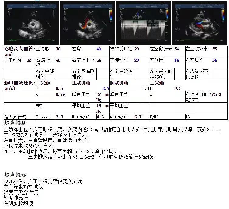 病例回顾与分享,腹膜后血肿介入治疗