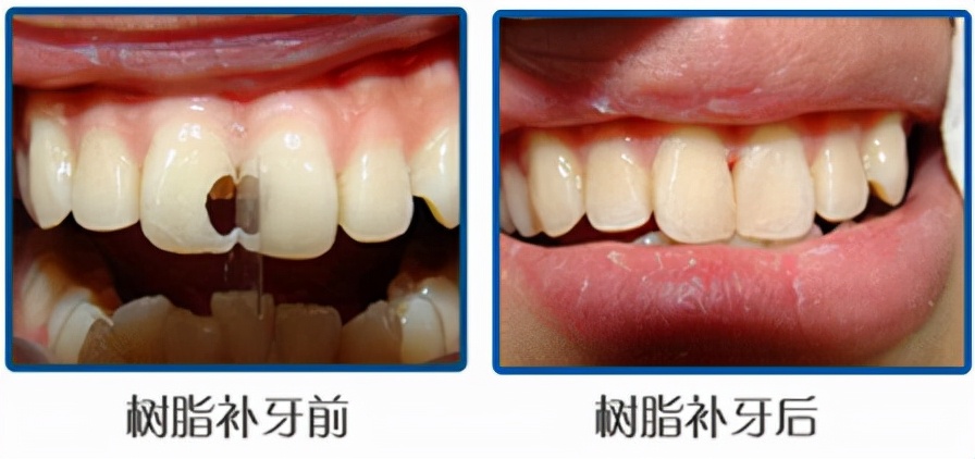 补牙几百对方要三千合理吗,同样是补牙为什么效果不一样