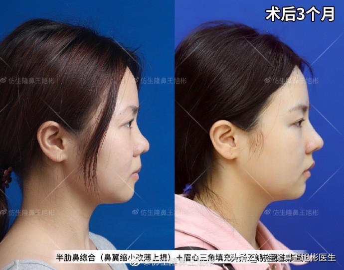 常见鼻部整形美容项目,整形鼻和自然鼻