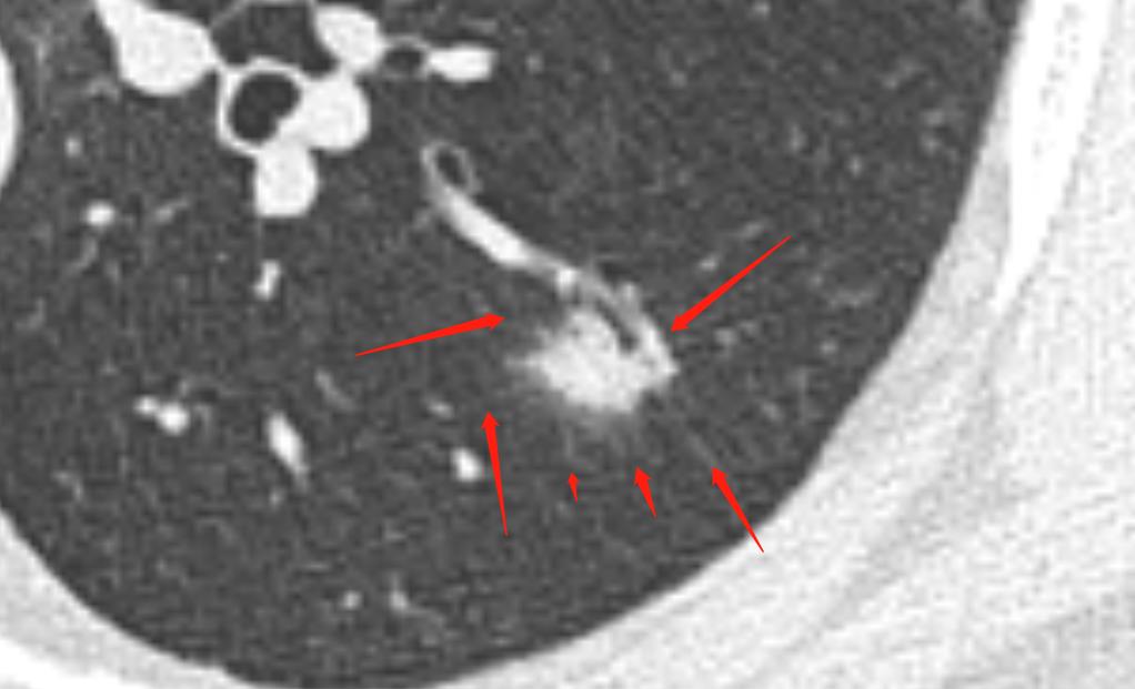 肺结节进一步检查排除肿瘤,肺结节4mm报告建议复查