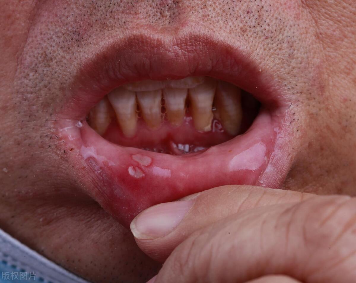 口臭1个小妙招10年口臭一去不复返,口臭根源与预防口臭妙招