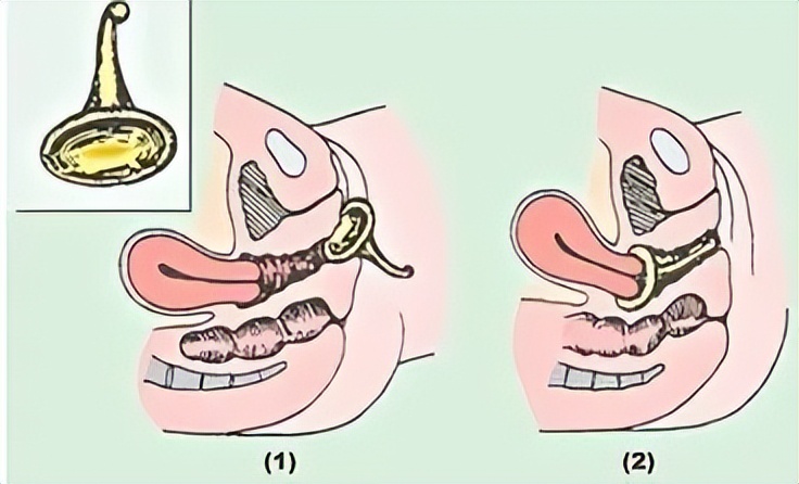 40岁女性漏尿是什么原因,40岁女性偶尔漏尿怎么回事