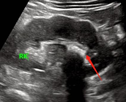 肾结石掉下来不疼,肾上的结石会引起腰痛吗