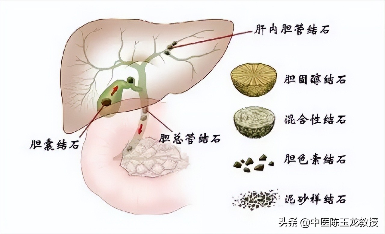 中医治疗膀胱结石经典处方,治疗胆结石肾结石膀胱结石的方子