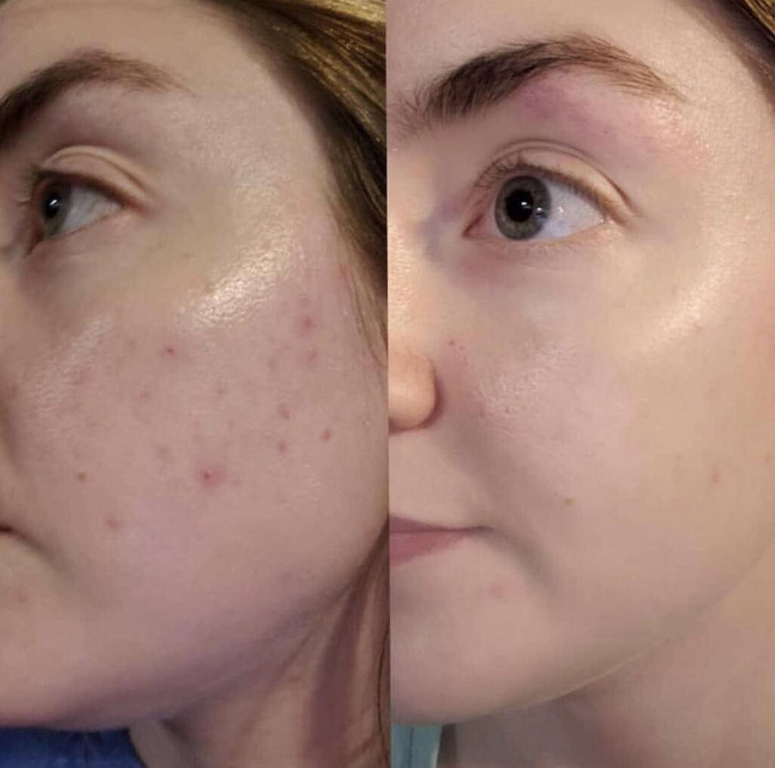 假期治痘最佳时期,如何快速消除熬夜痘