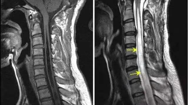 磁共振脊髓空洞影像学表现,脊髓空洞核磁表现增强