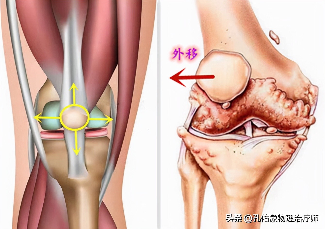 哪些疾病会出现膝关节疼痛的表现,膝关节疼痛原因平时应该在意哪些
