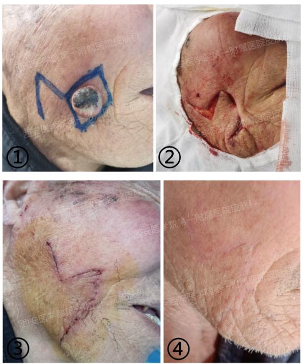 老人脸上长黑色鳞状肉瘤,老人脸上长个肉疙瘩癌变