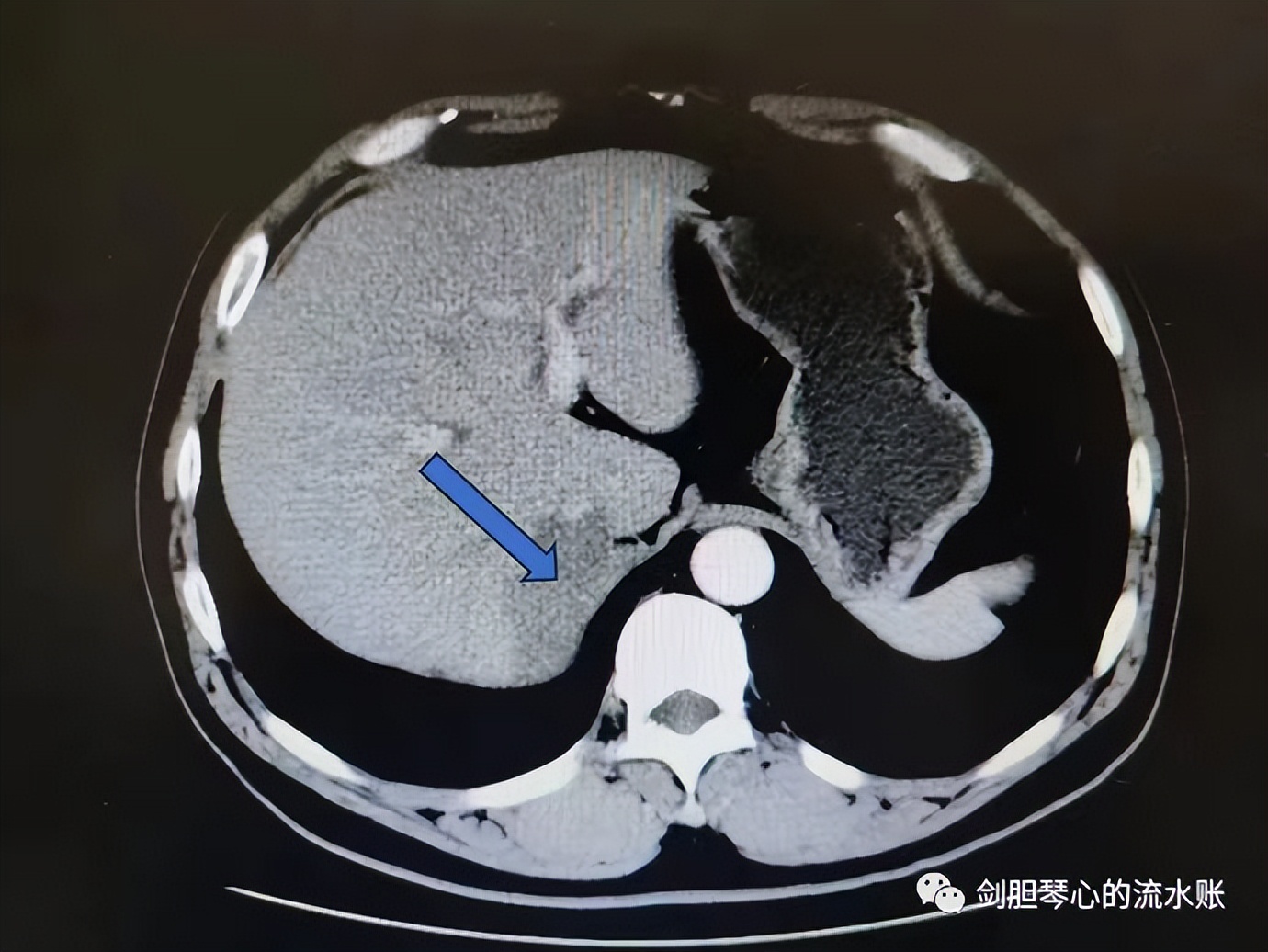 左肺下叶肺隔离症需手术吗,左肺下叶肺隔离症是什么意思