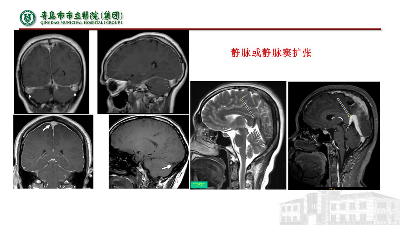 低颅压综合征耳闷,低颅压综合征吃什么药