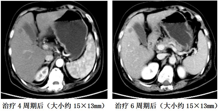 全国治胃癌最好的化疗方案,肿瘤科常见化疗方案解读