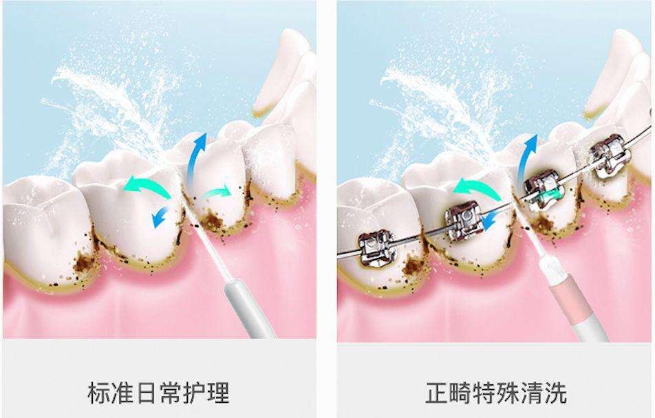 超声波冲牙器危害,经常用冲牙器对牙齿有危害吗