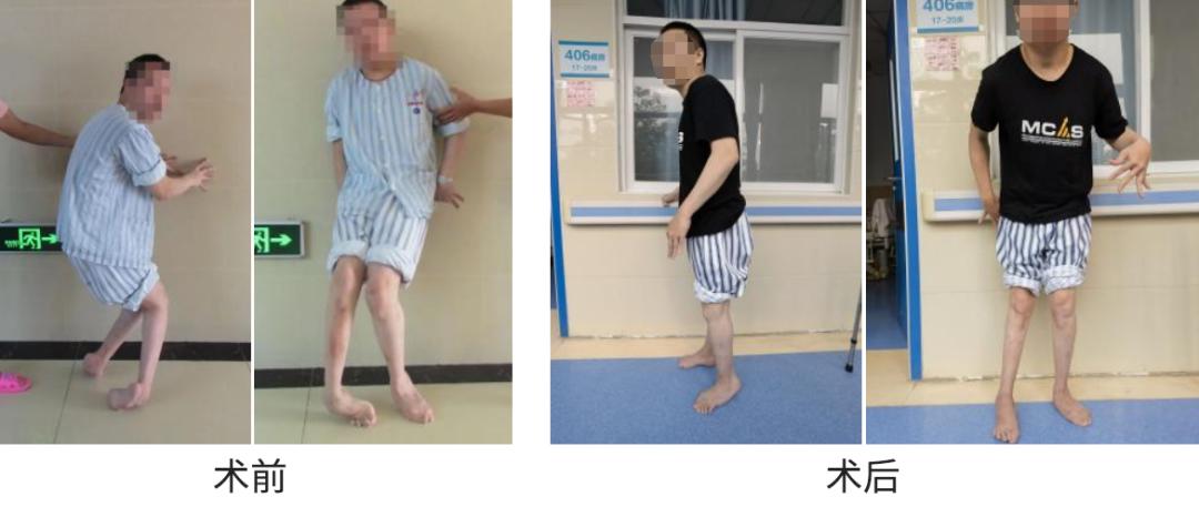 “走路的感觉真好。”手术让20多岁的脑瘫患者迈出人生第一步