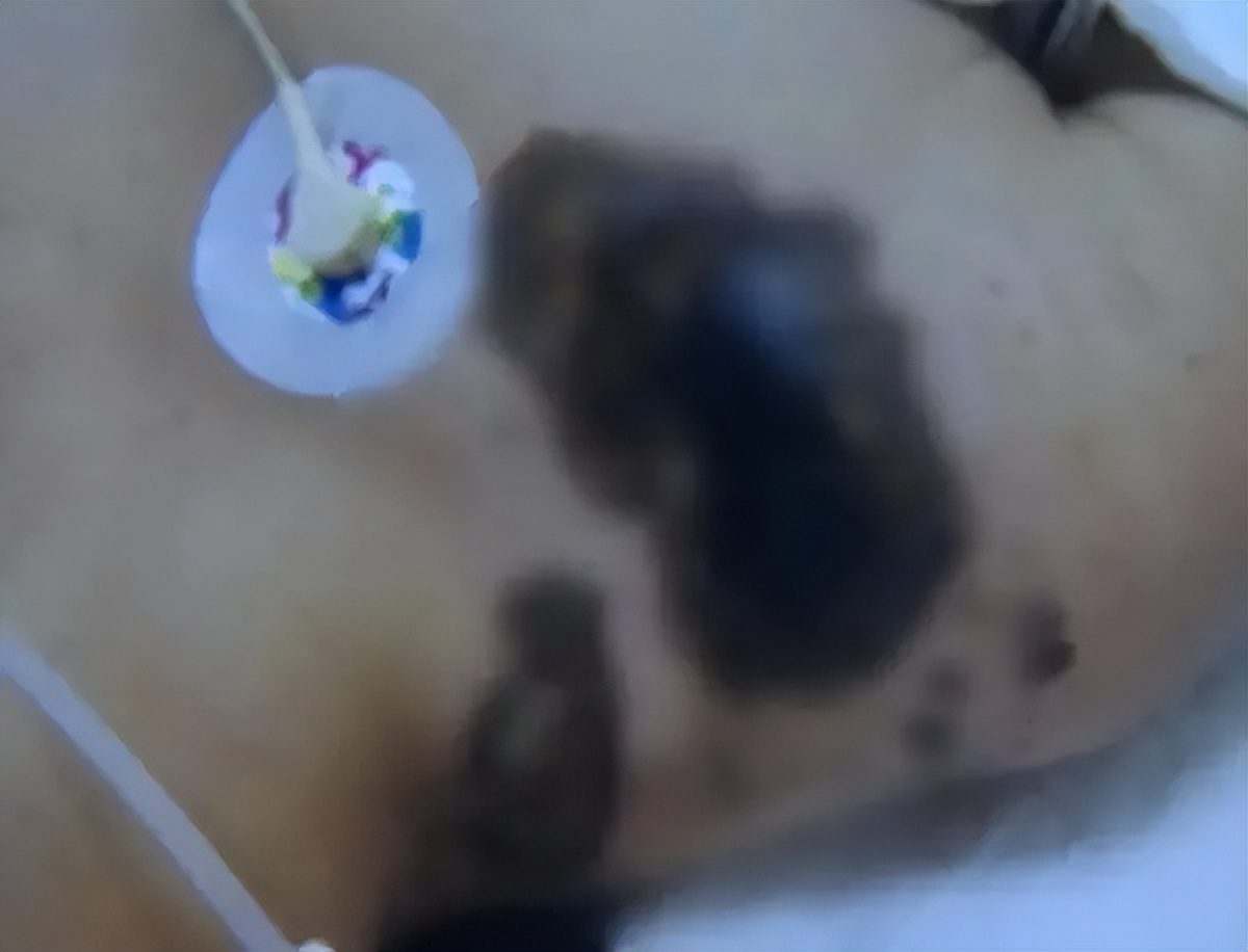 女孩苹果手机充电被电击内脏受损,女子被苹果充电器电截肢