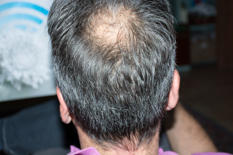 白头发越拔越多有科学依据吗,民间为什么说白头发不能拔