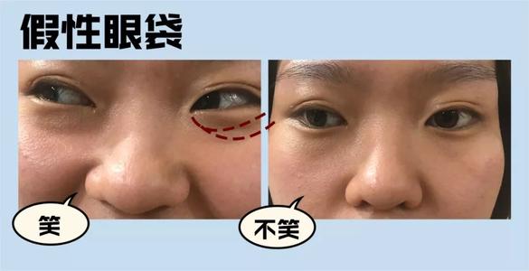 上海第九人民医院不开刀去除眼袋,顽固眼袋别担心不开刀也能变好看
