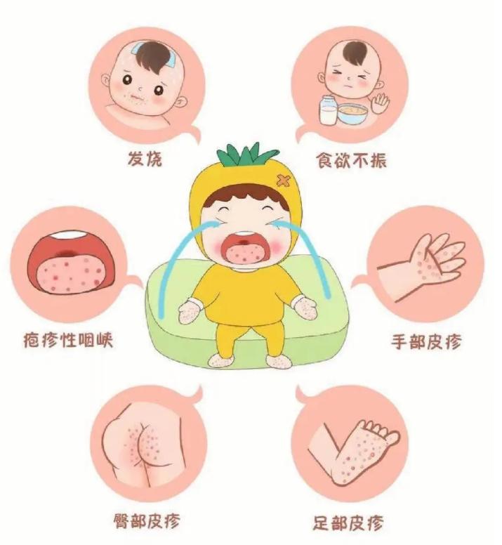 手足口病严重怎么治疗最快,古代中医辨证治疗手足口病