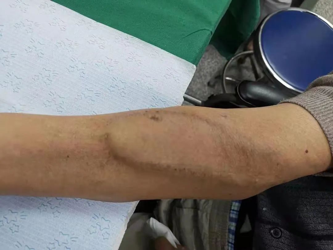 人工血管透析的效果,人工血管血液透析