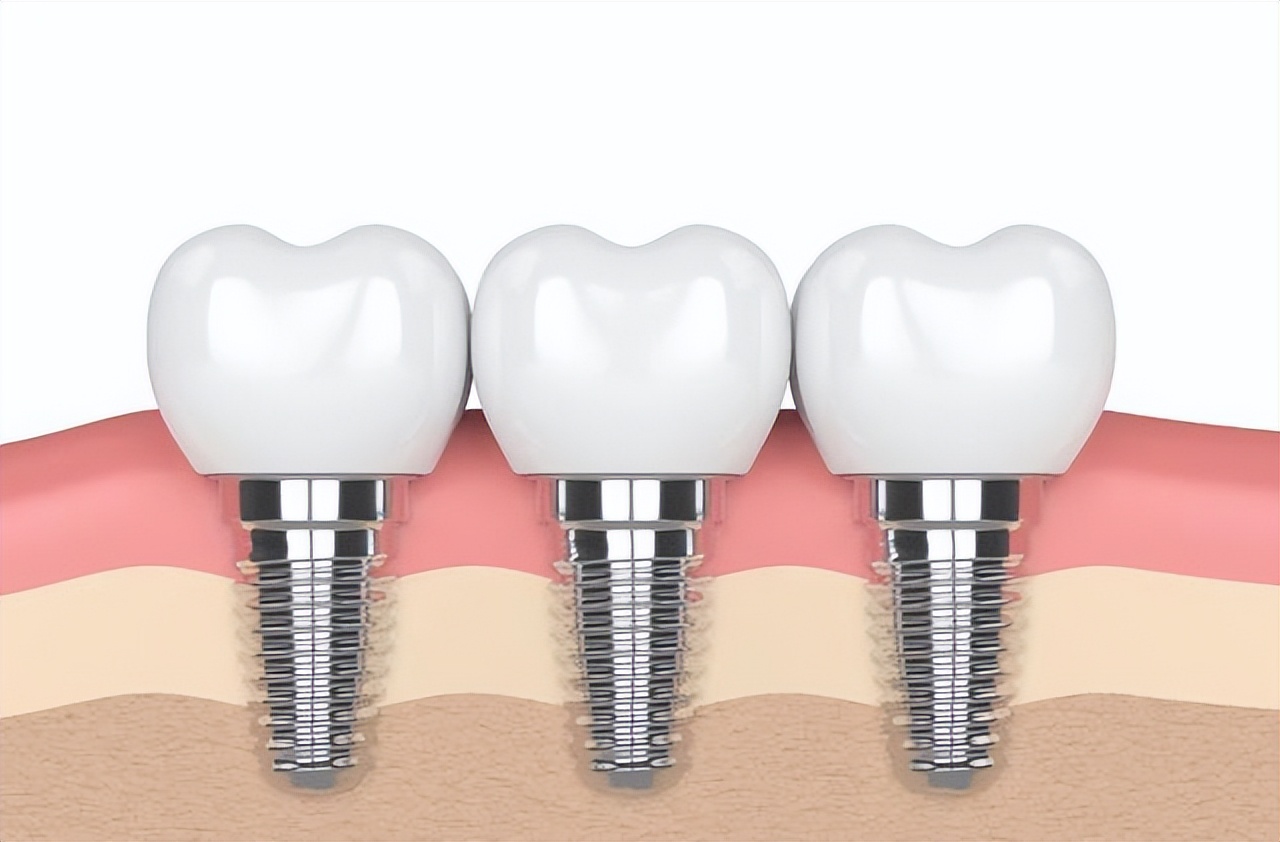 种植牙一般能坚持多少年,种植牙一般能维持几年