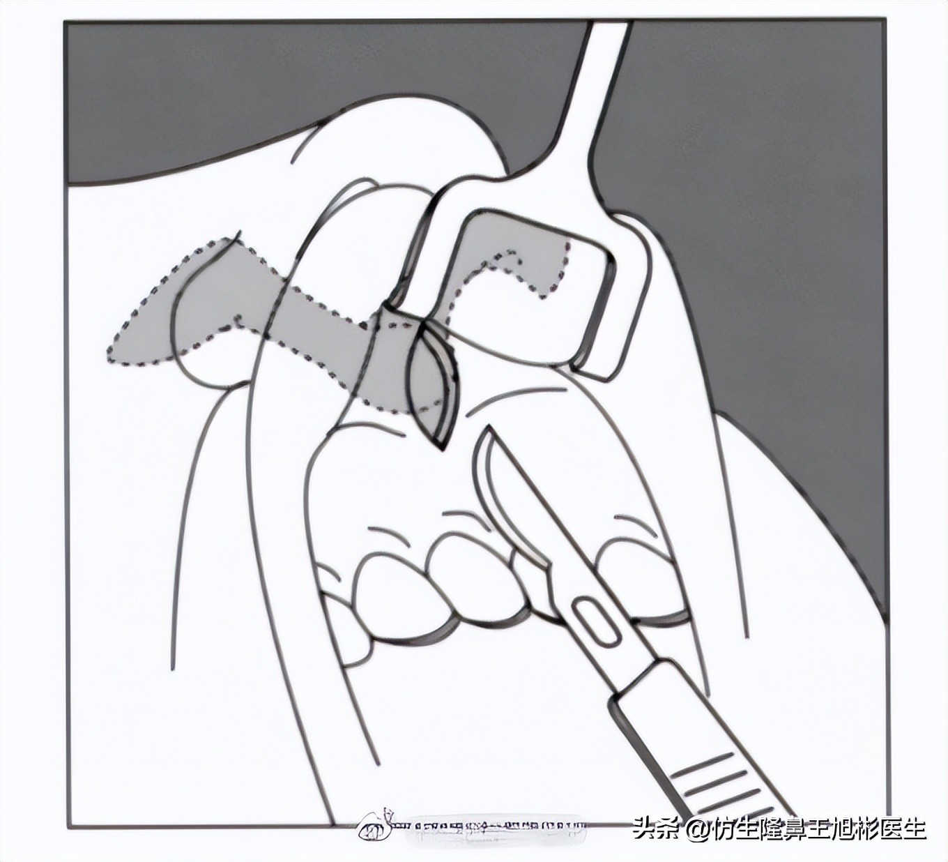 鼻基底填充会移位到鼻孔吗,鼻基底填充假体会拉长人中吗