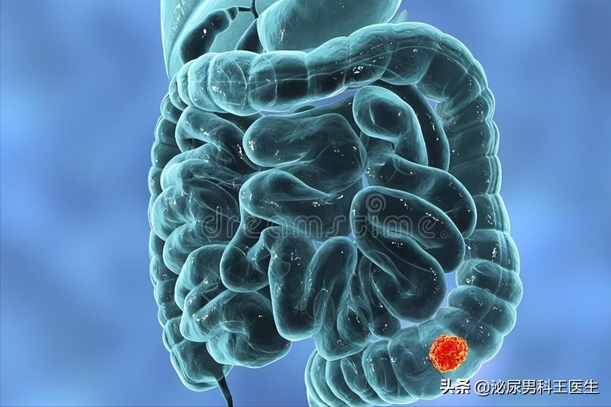 直肠癌的6个早期症状是一起出现,直肠癌出现便秘早期还是晚期