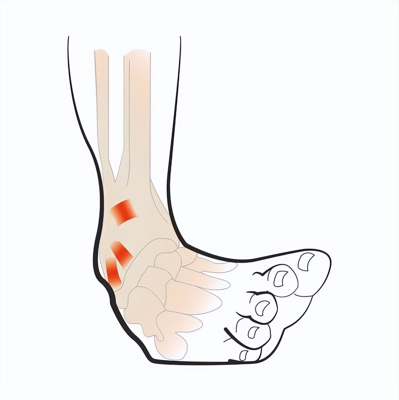 滑雪摔到髋骨韧带损伤,滑雪伤到踝关节