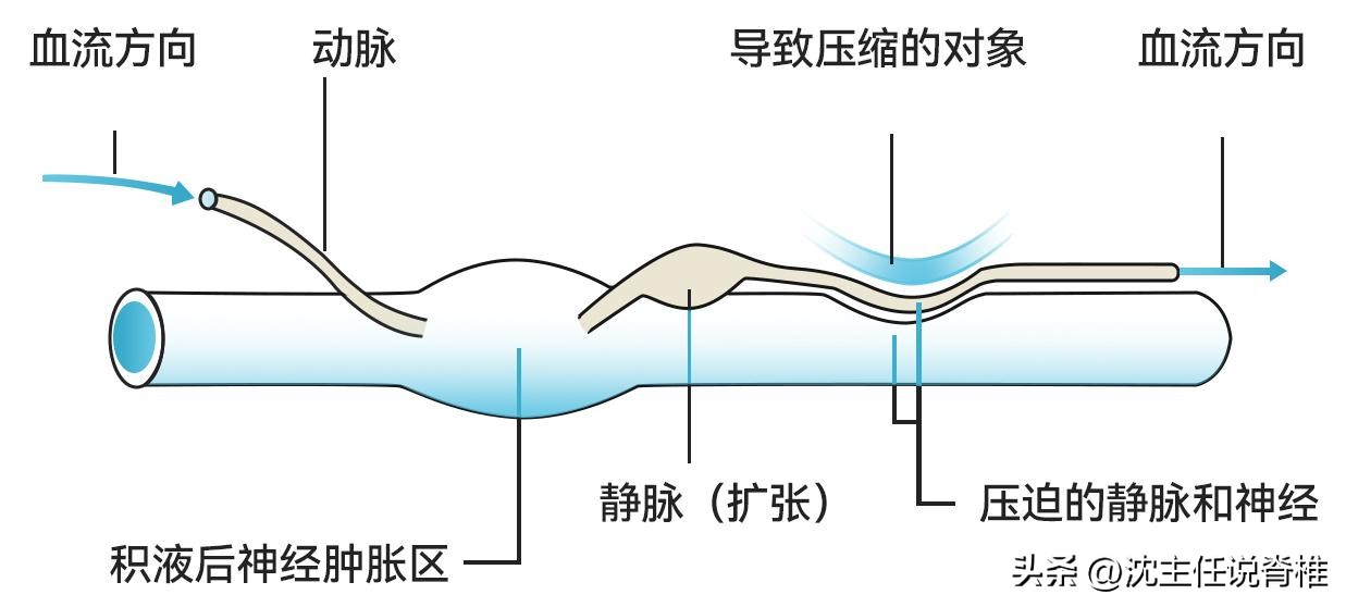 仰头肩膀牵扯痛怎么办,仰头手发麻怎么缓解