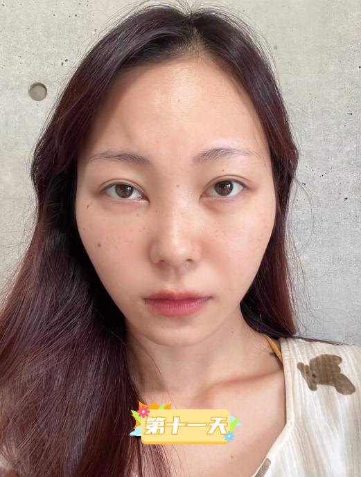 内切去眼袋手术全过程,做了去眼袋手术五天怎么还有眼袋