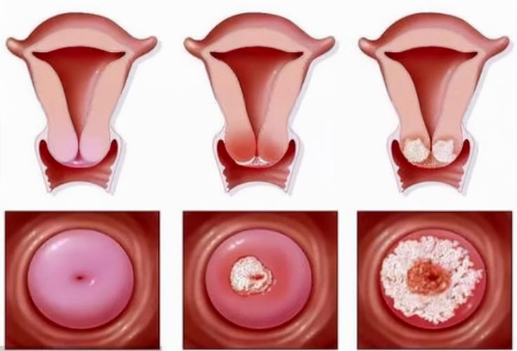 【科普】子宫内膜癌有两种类型，你了解吗？腹腔镜手术效果如何？