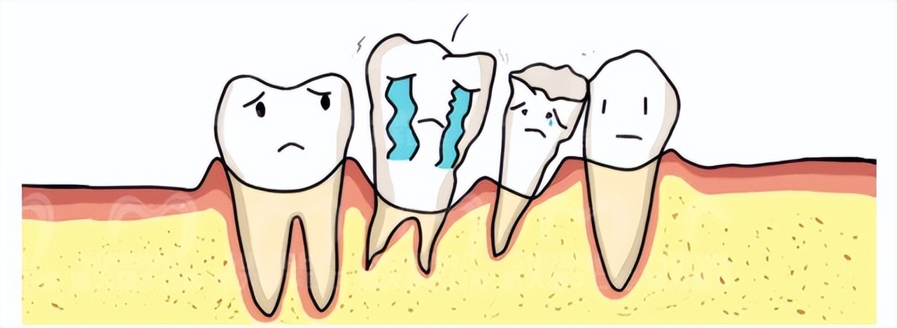 种植牙一般能用几年,种植牙一般能用几年最好呢