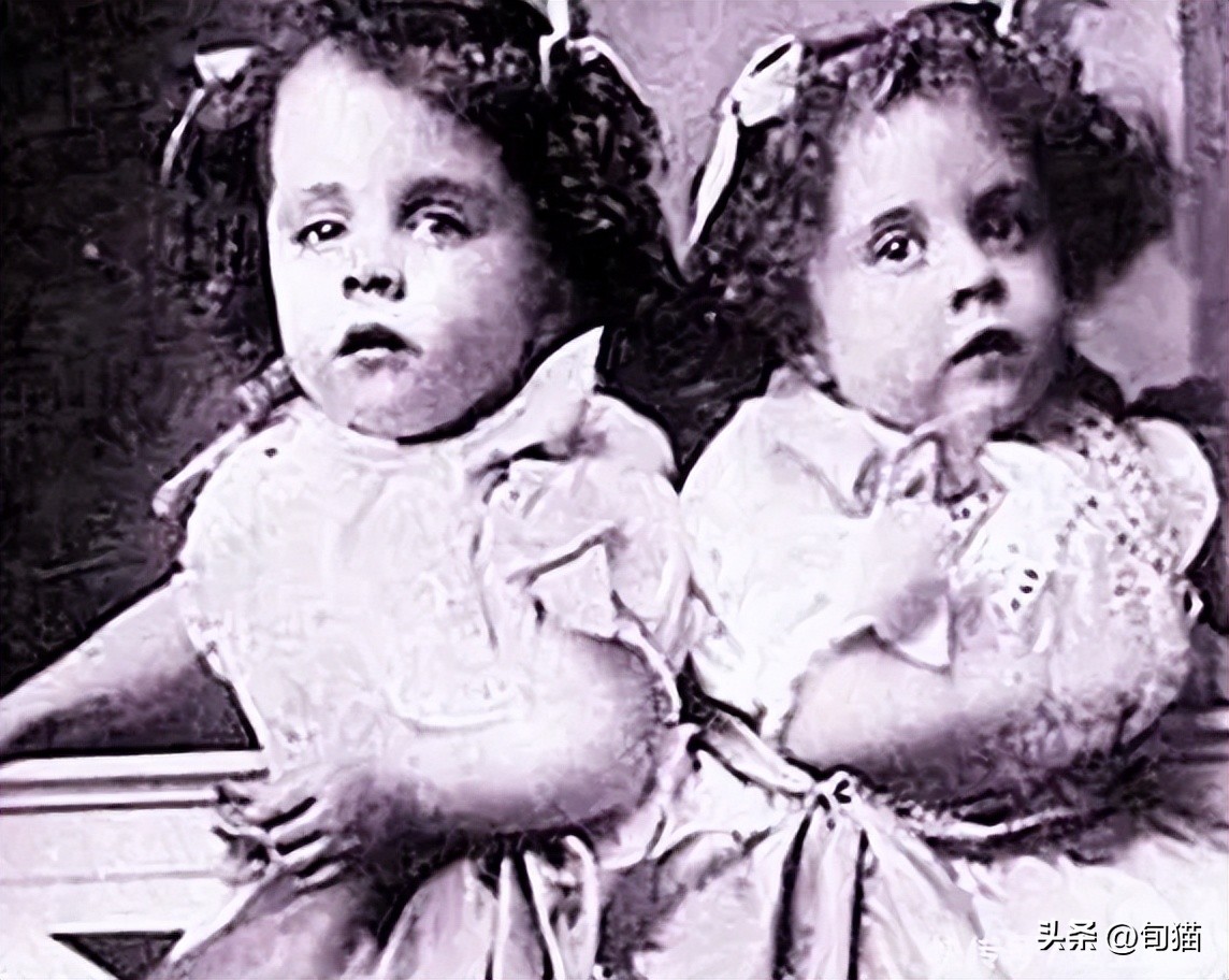 连体姐姐死亡原因,姐妹连体手术分离姐姐去世