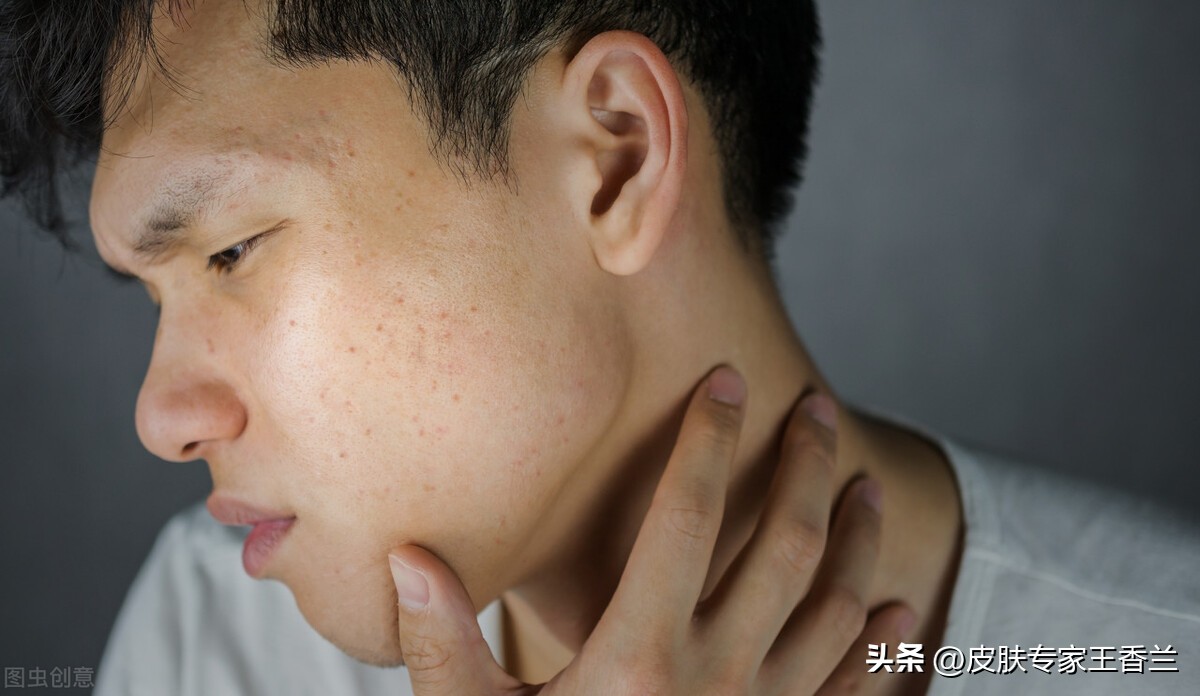 出油毛孔粗大长痘痘怎么改善,皮肤长痘油腻毛孔粗大怎么改善