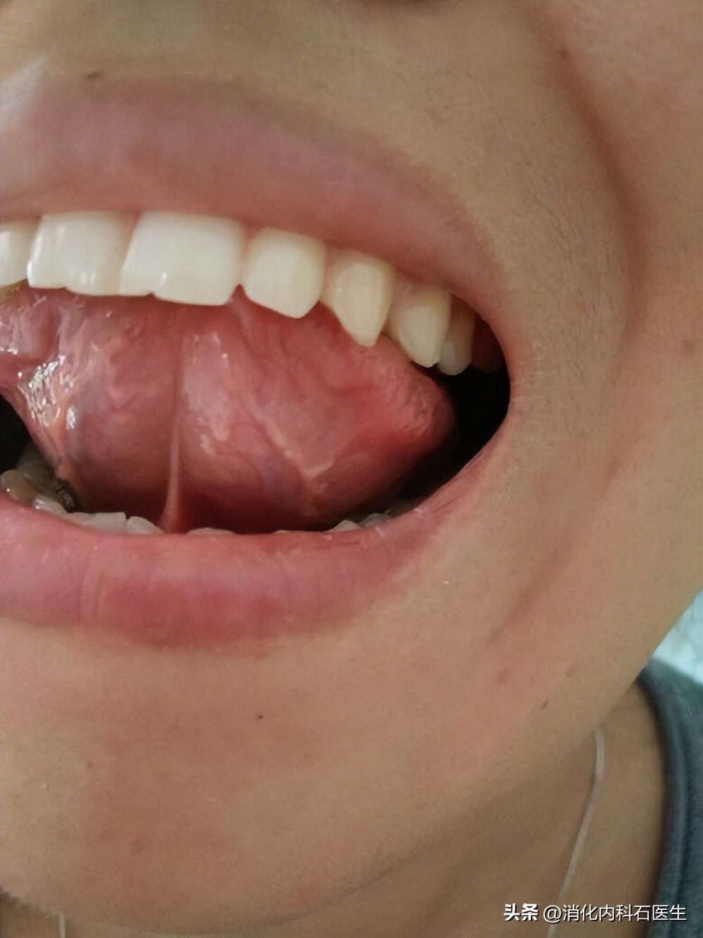 女子新婚之夜舌头出血,影响生活,确诊后女子绝望地走到了19楼顶