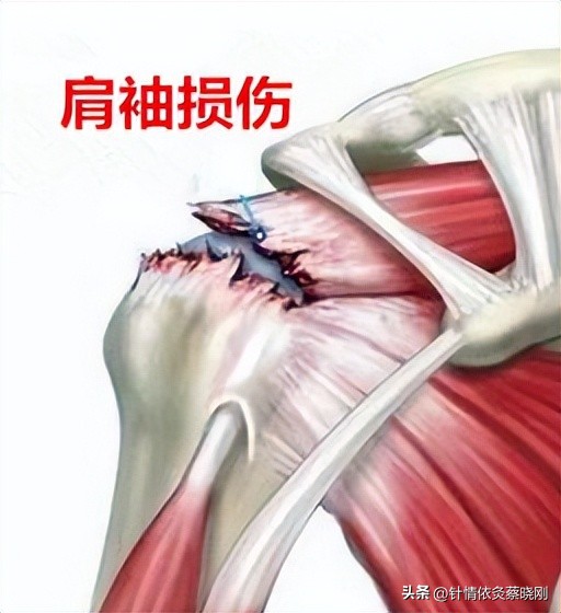 肩袖损伤针灸治疗可以吃药吗,肩袖损伤针灸特效穴