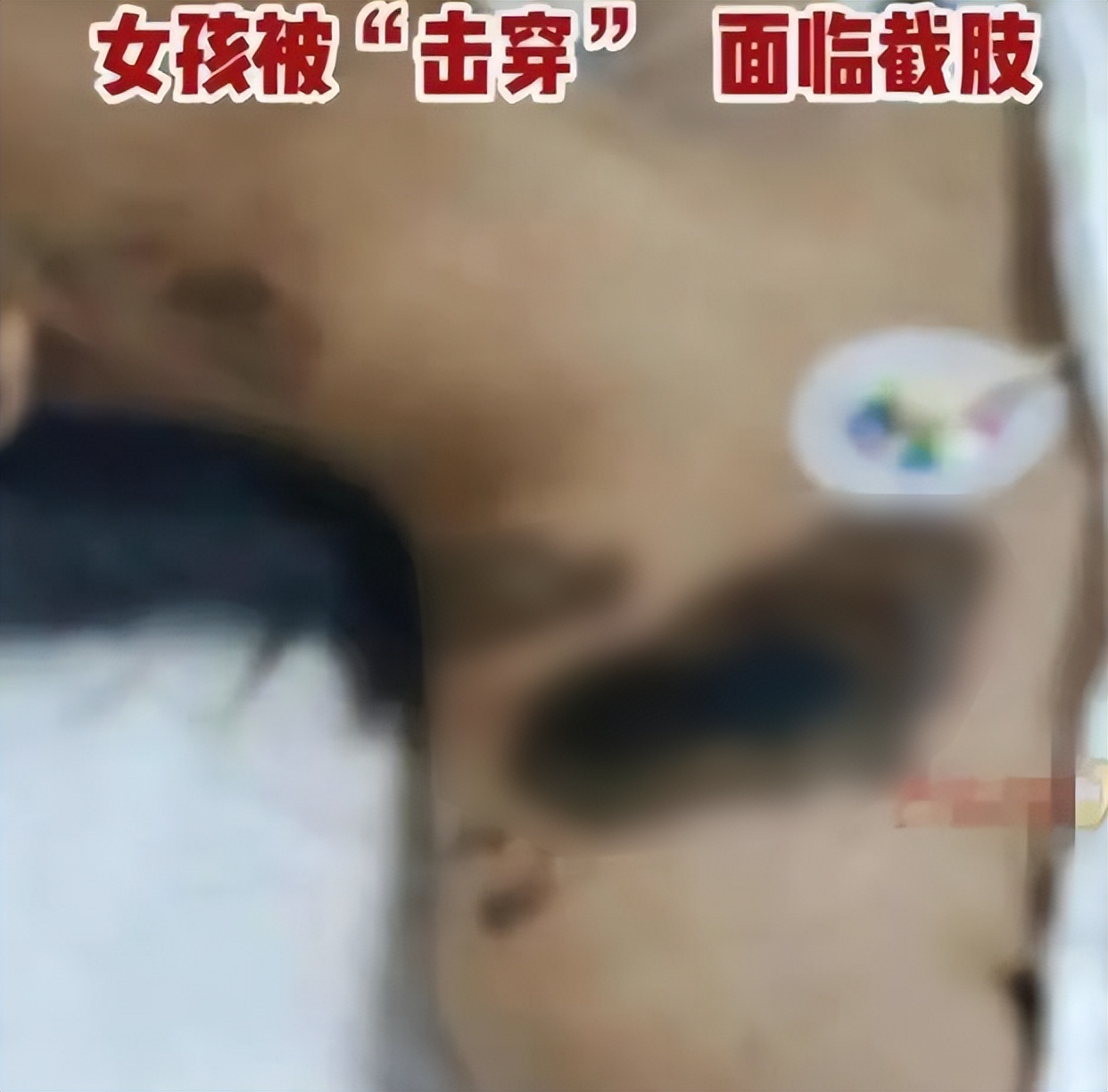 女孩iphone充电被电击面临截肢,iphone边充边玩被电击