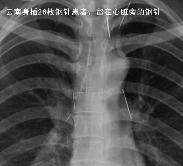 云南女子体内26根绣花针凶手是谁,云南女子缝衣针