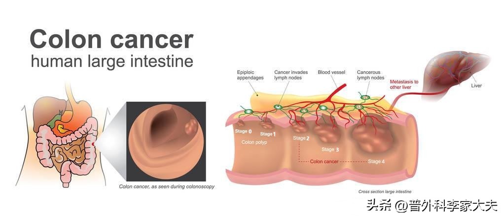 结肠癌肝转移最好的中医是谁,结肠癌肝转移老人抗癌视频