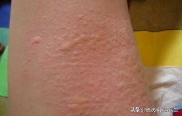 麻疹病人的治疗原则,荨麻疹吃中药有什么要忌口的