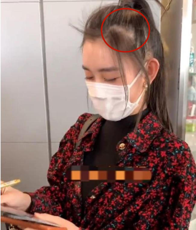 盘点女明星发际线危机,女明星秃头前后对比