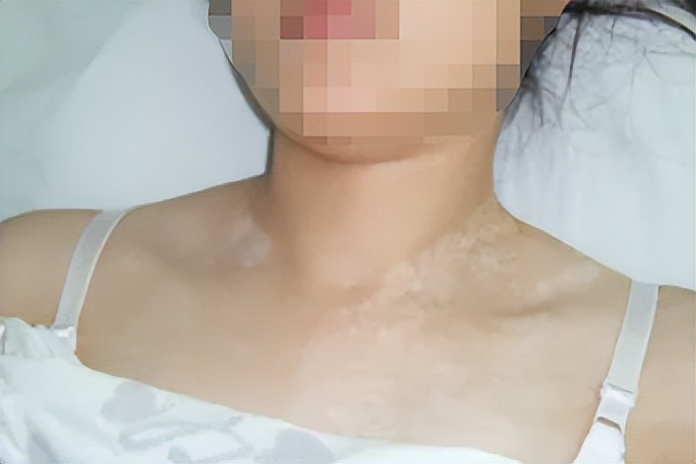 产后为什么会出现白斑？准妈妈哺乳期得了白癜风怎么办？